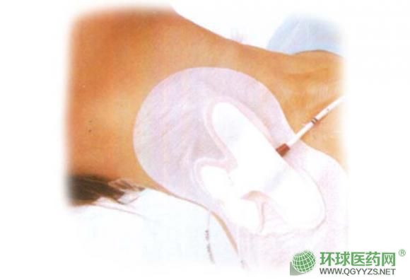 耗材體表導(dǎo)管固定裝置